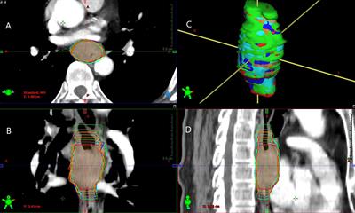 Inter-Observer and Intra-Observer Variability in Gross Tumor Volume Delineation of Primary Esophageal Carcinomas Based on Different Combinations of Diagnostic Multimodal Images